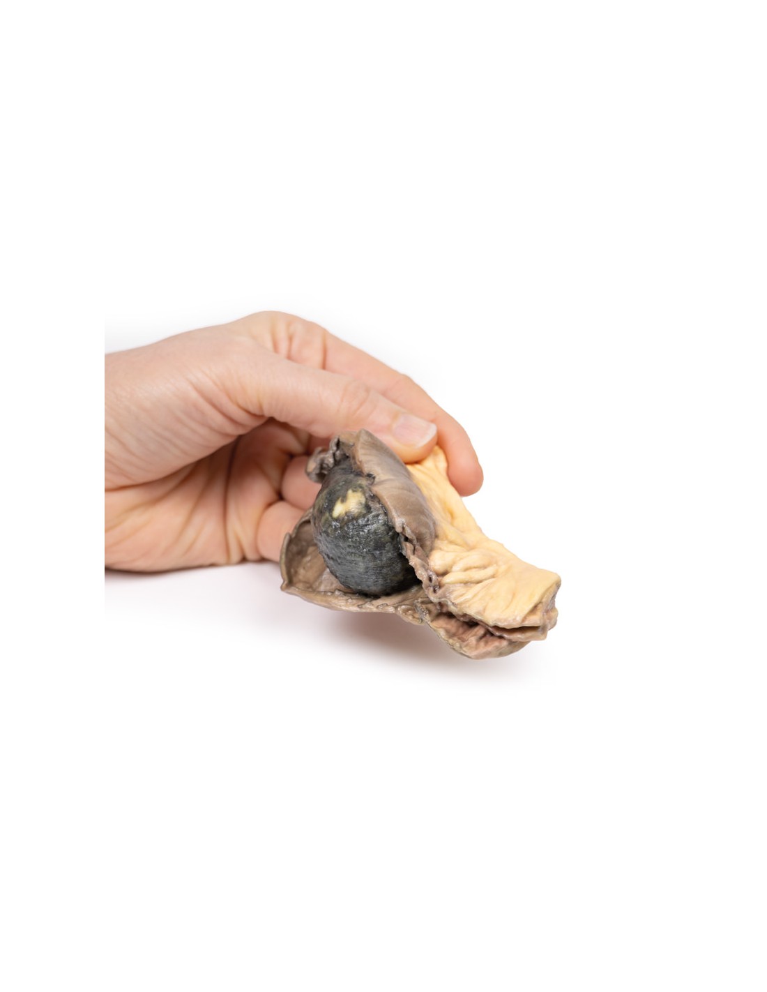 Íleo con piedras - Erler Zimmer 3D... Íleo con piedras - Erler Zimmer 3D...