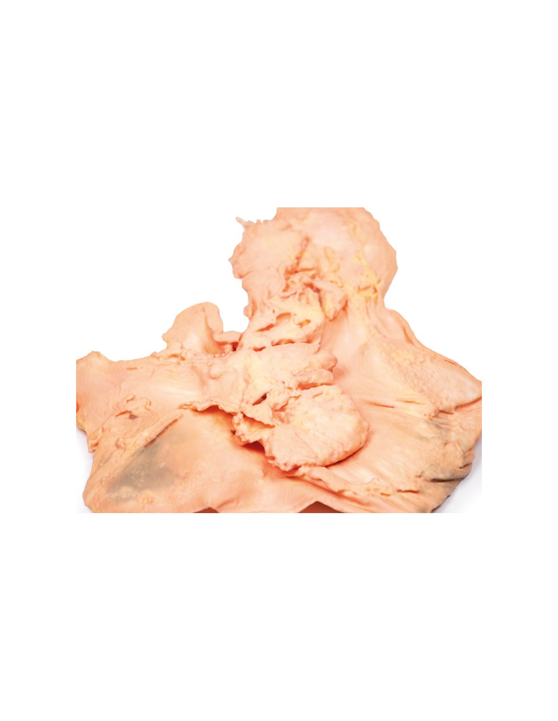 Adenocarcinoma de estómago - Erler... Adenocarcinoma de estómago - Erler...