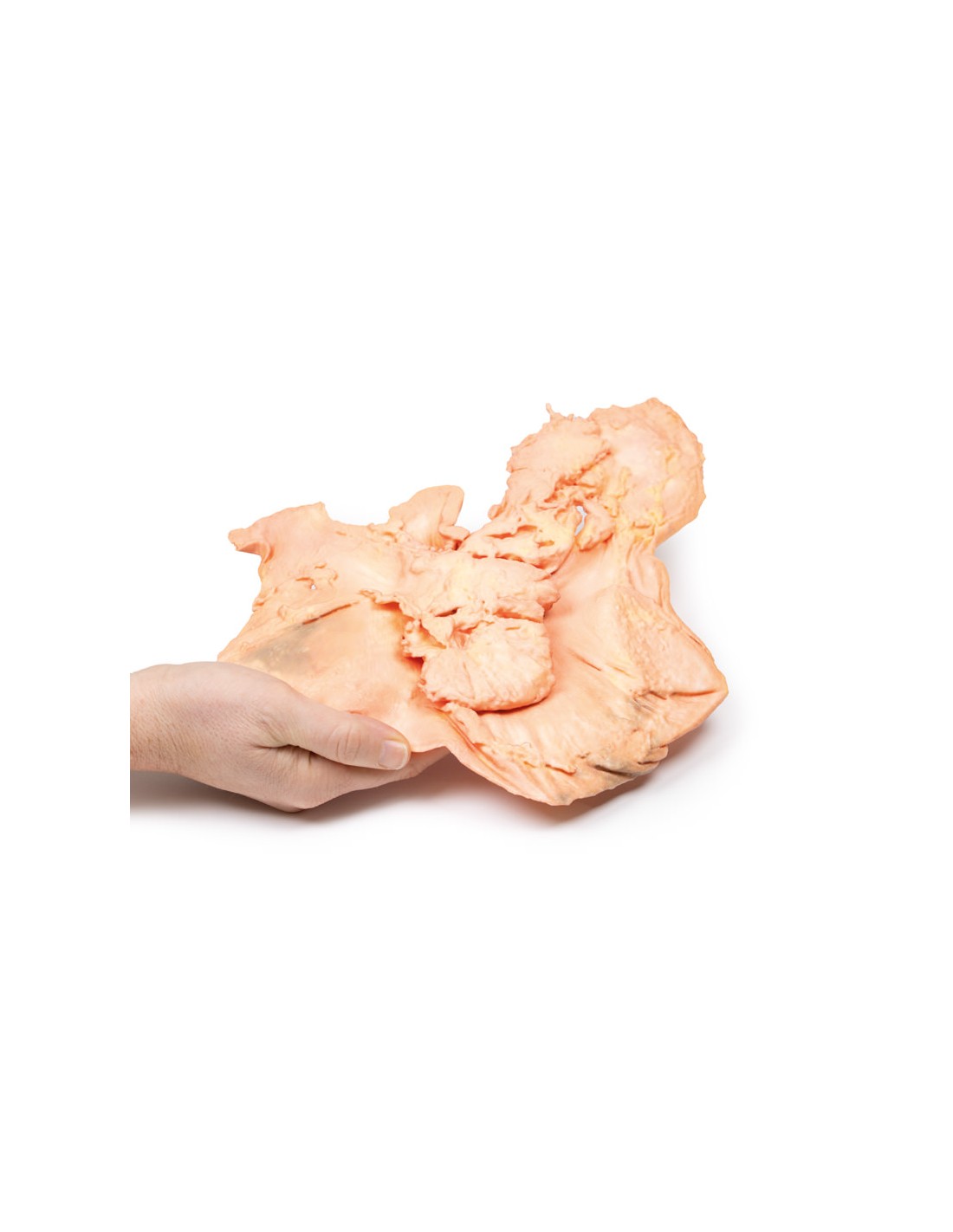Adenocarcinoma de estómago - Erler... Adenocarcinoma de estómago - Erler...