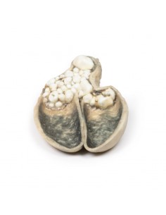 Colecistitis y colelitiasis...