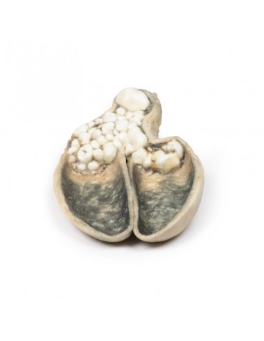 Colecistitis y colelitiasis - Erler... Colecistitis y colelitiasis - Erler...
