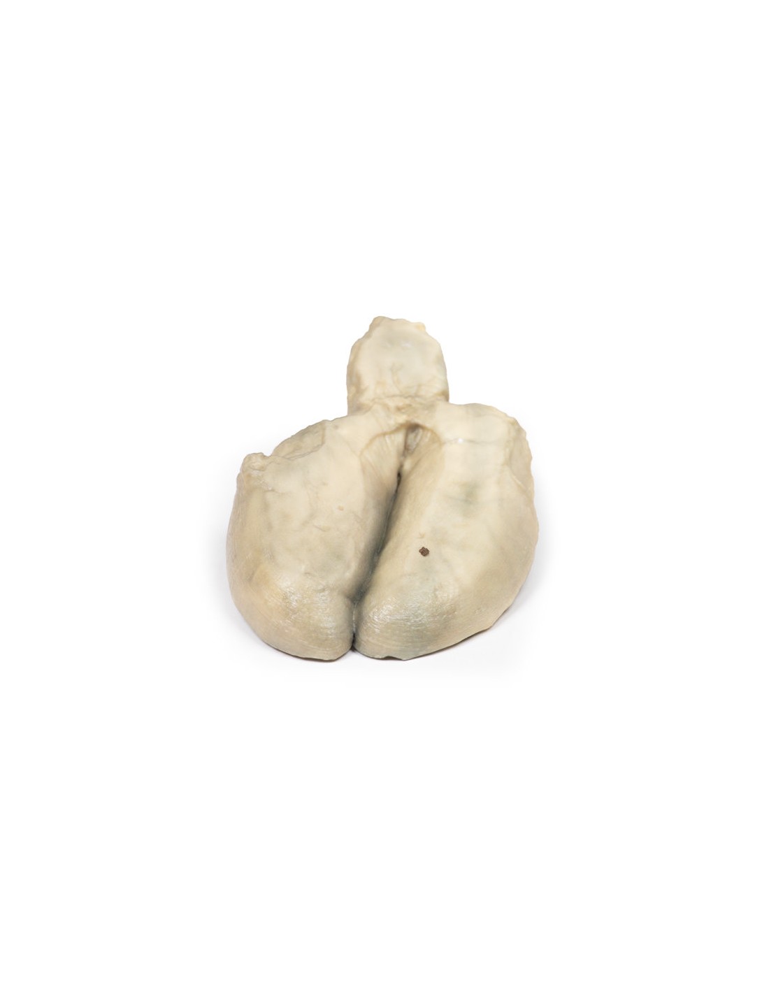 Colecistitis y colelitiasis - Erler... Colecistitis y colelitiasis - Erler...