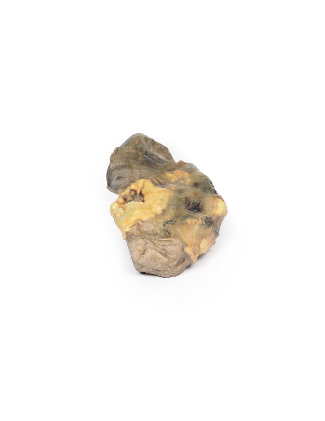 Pionefrosis - Erler Zimmer 3D anatomy... Pionefrosis - Erler Zimmer 3D anatomy...