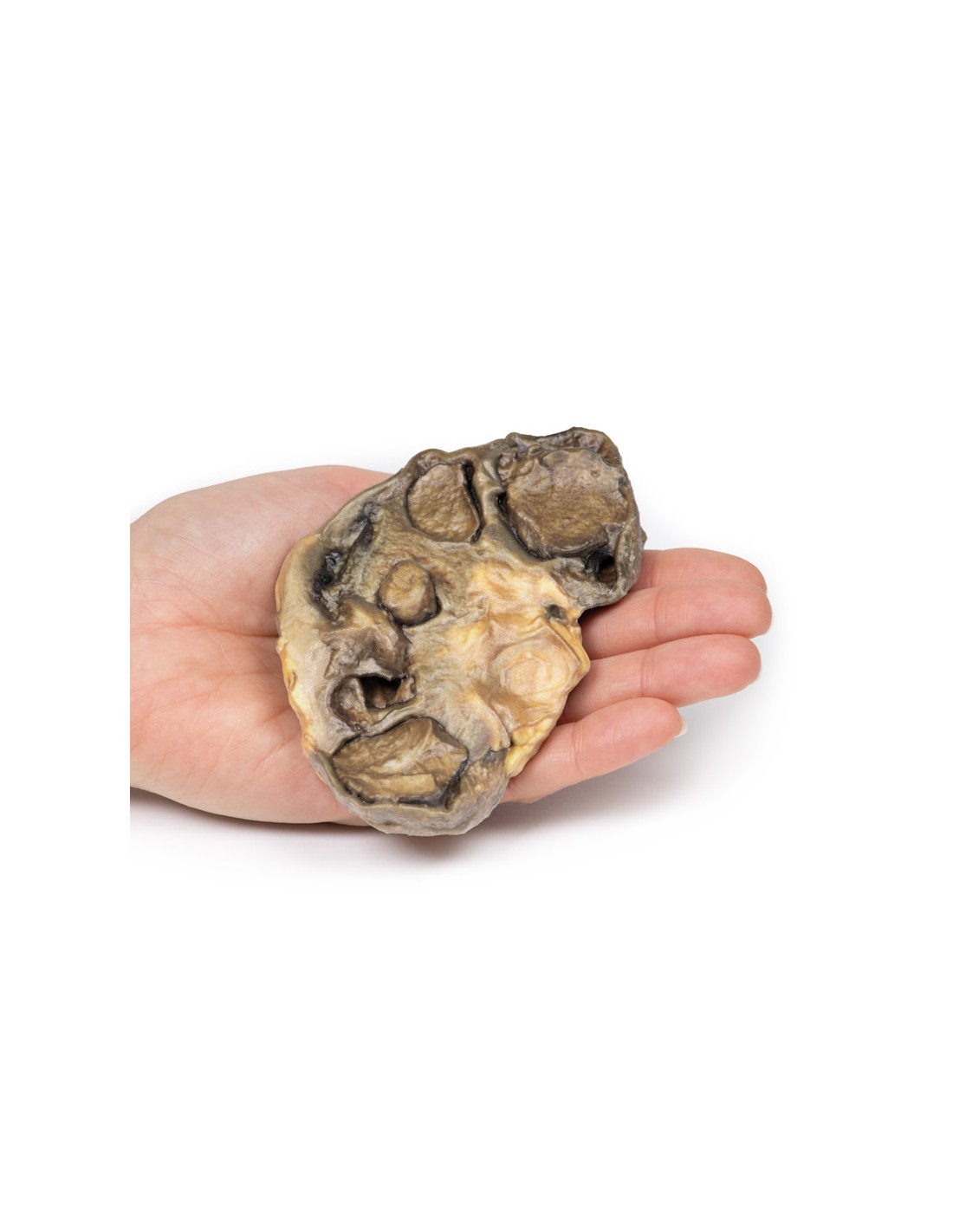 Pionefrosis - Erler Zimmer 3D anatomy... Pionefrosis - Erler Zimmer 3D anatomy...
