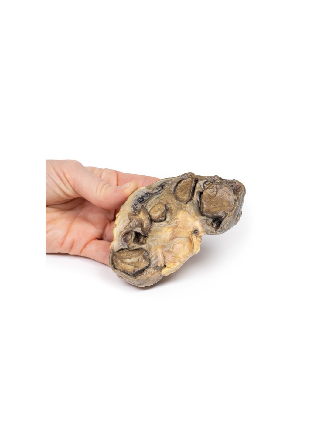 Pionefrosis - Erler Zimmer 3D anatomy... Pionefrosis - Erler Zimmer 3D anatomy...