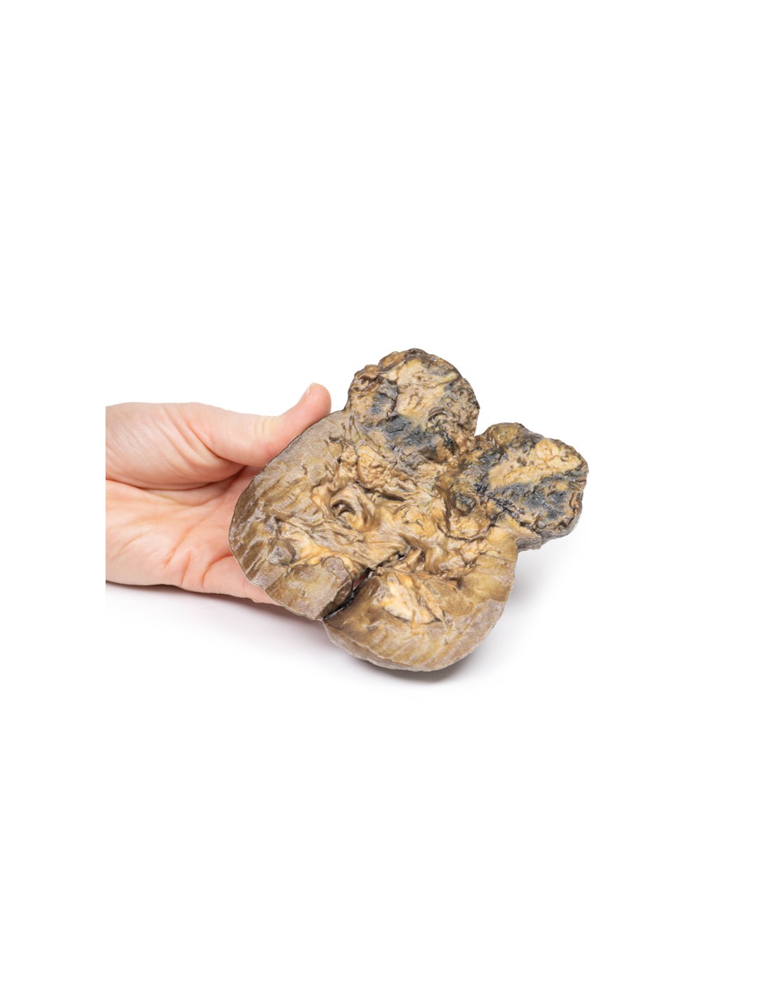 Carcinoma de células renales - Erler... Carcinoma de células renales - Erler...