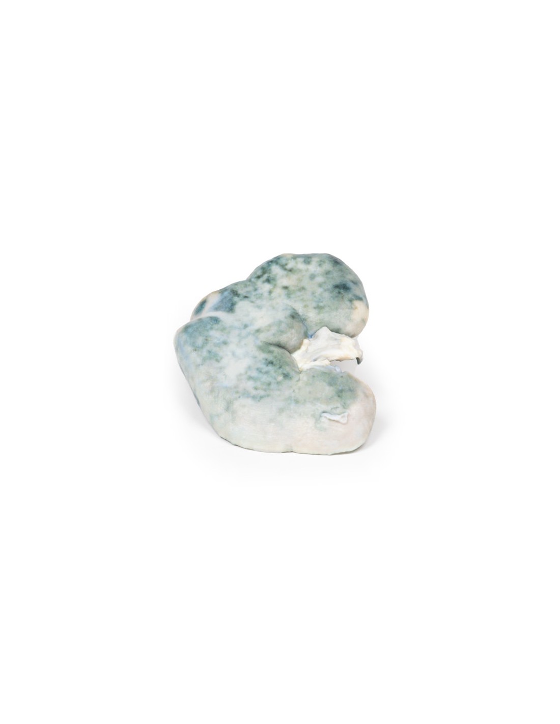Infarto renal - Erler Zimmer 3D... Infarto renal - Erler Zimmer 3D...
