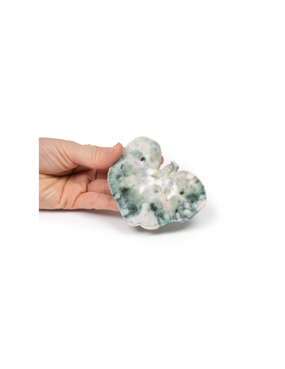 Infarto renal - Erler Zimmer 3D... Infarto renal - Erler Zimmer 3D...