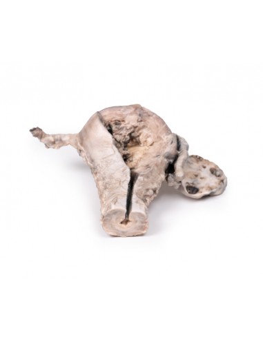 Cáncer endometrial - Erler Zimmer 3D... Cáncer endometrial - Erler Zimmer 3D...