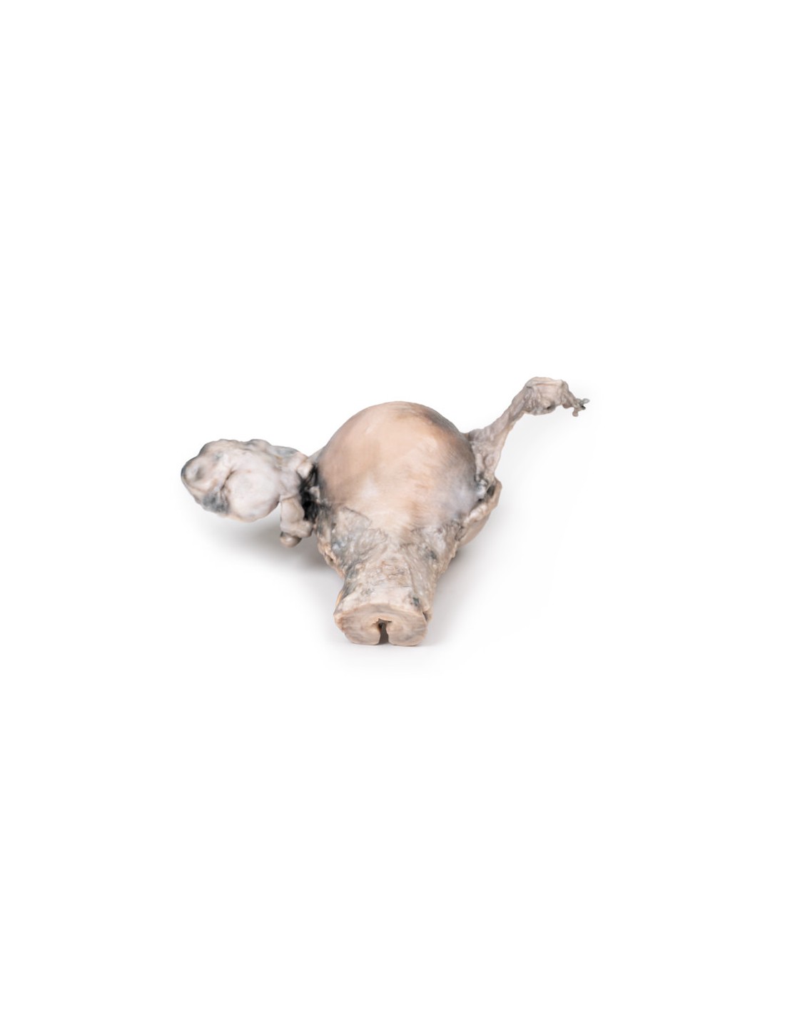 Cáncer endometrial - Erler Zimmer 3D... Cáncer endometrial - Erler Zimmer 3D...