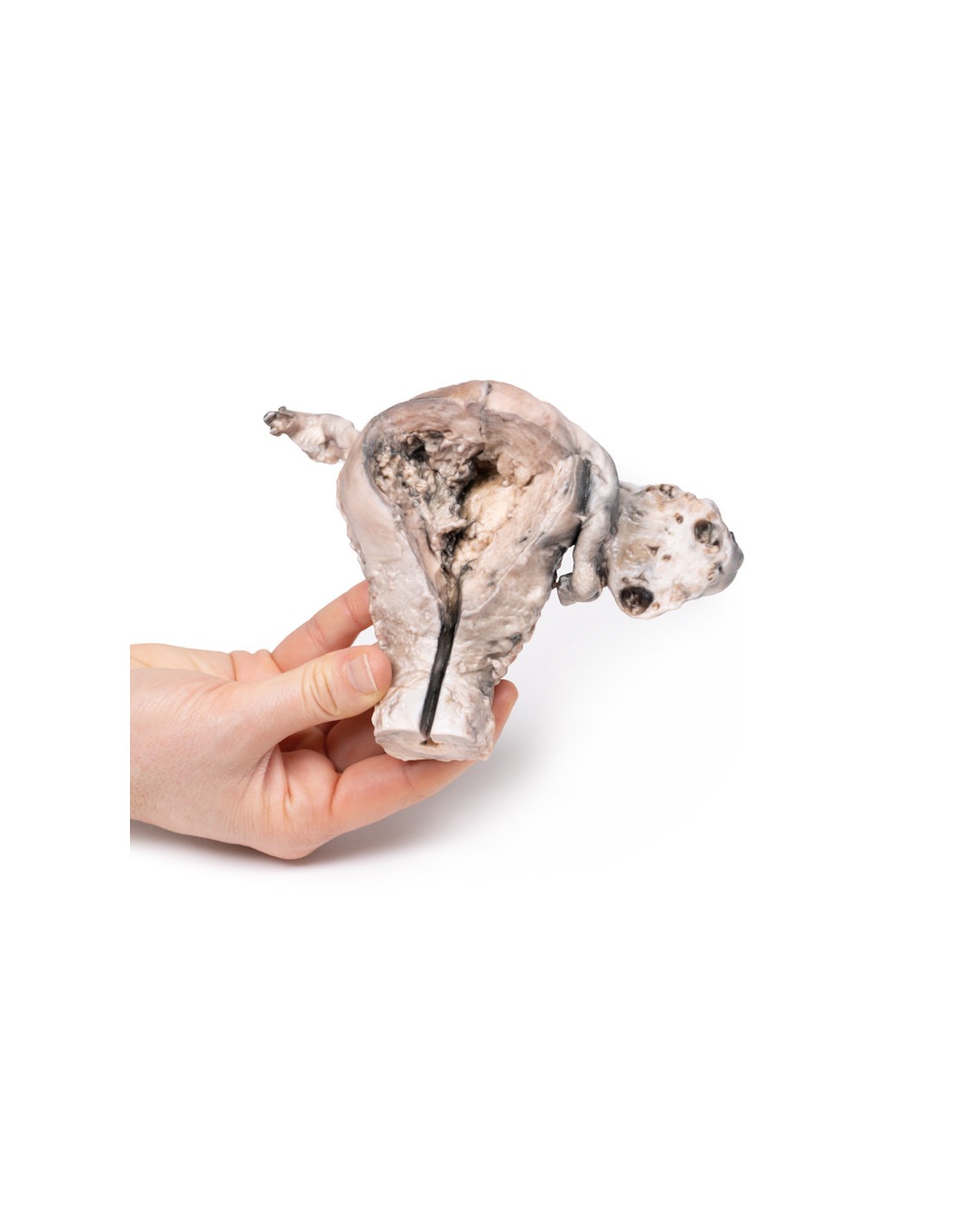 Cáncer endometrial - Erler Zimmer 3D... Cáncer endometrial - Erler Zimmer 3D...