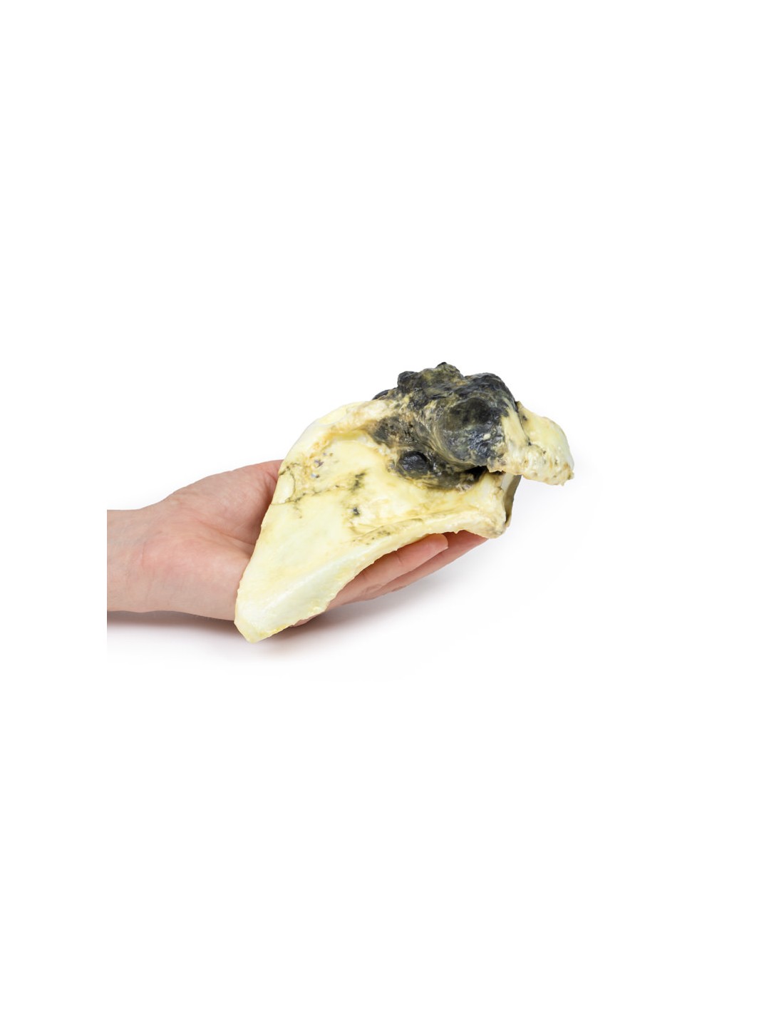 Condrosarcoma de la escápula - Erler... Condrosarcoma de la escápula - Erler...