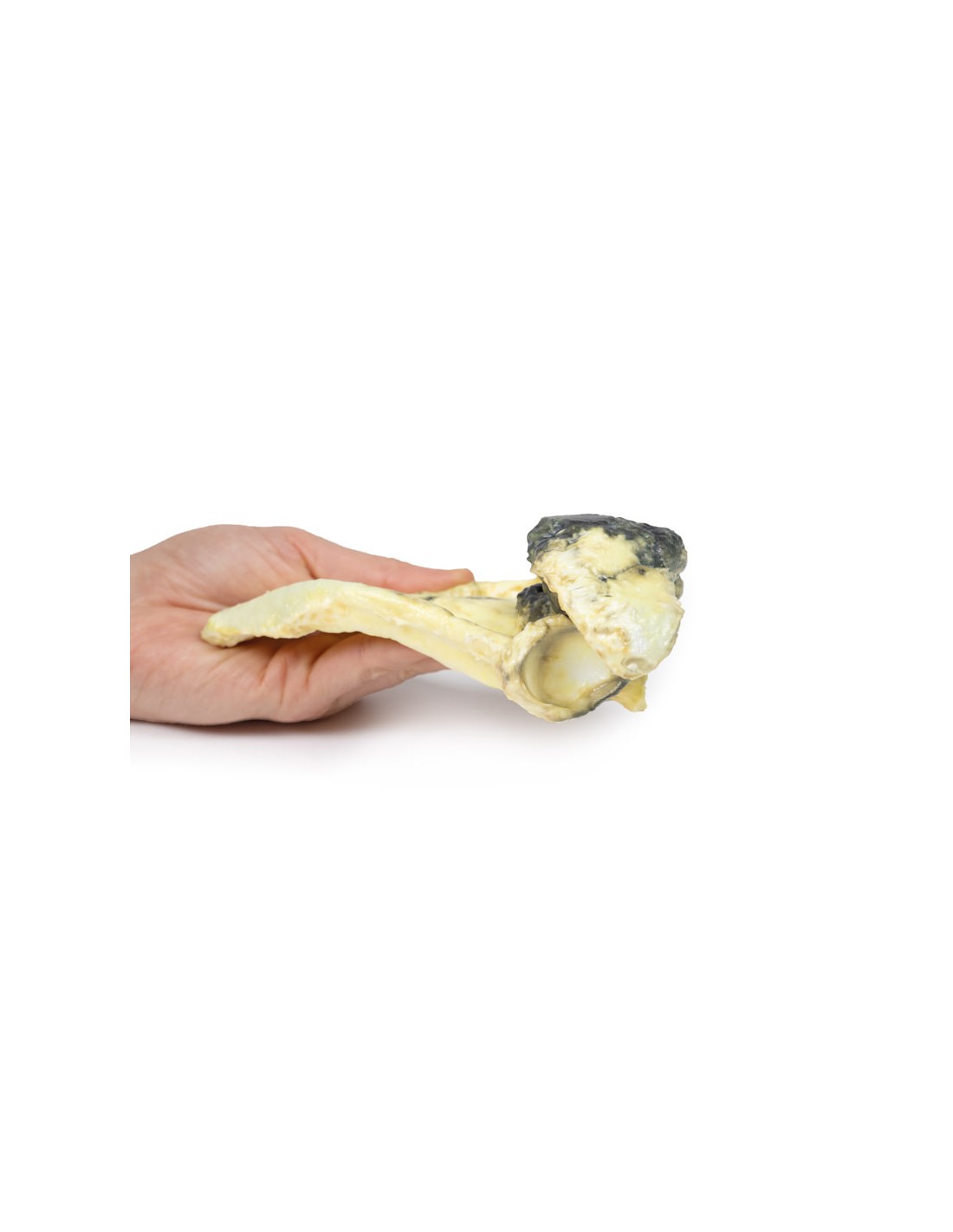 Condrosarcoma de la escápula - Erler... Condrosarcoma de la escápula - Erler...