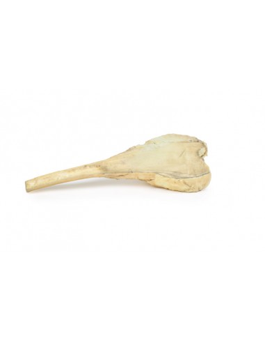 Osteosarcoma del fémur - Erler Zimmer... Osteosarcoma del fémur - Erler Zimmer...