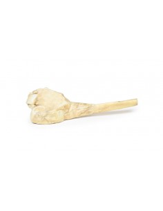 Osteosarcoma del fémur -... 2