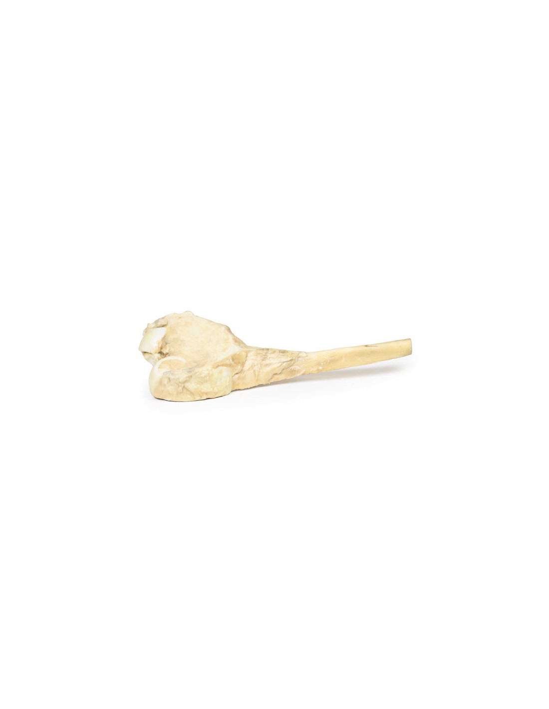 Osteosarcoma del fémur - Erler Zimmer... Osteosarcoma del fémur - Erler Zimmer...