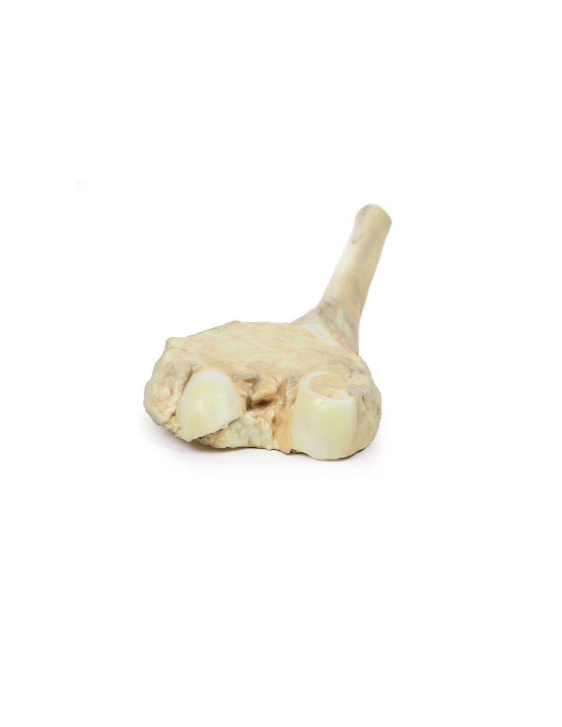 Osteosarcoma del fémur - Erler Zimmer... Osteosarcoma del fémur - Erler Zimmer...