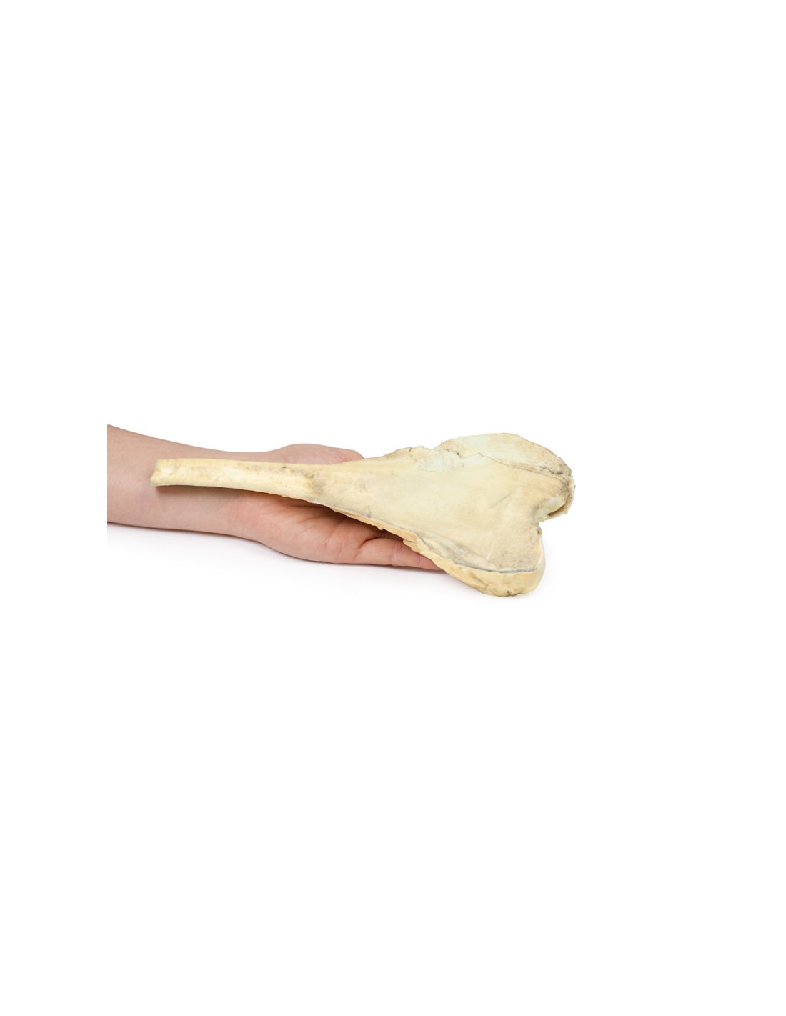 Osteosarcoma del fémur - Erler Zimmer... Osteosarcoma del fémur - Erler Zimmer...