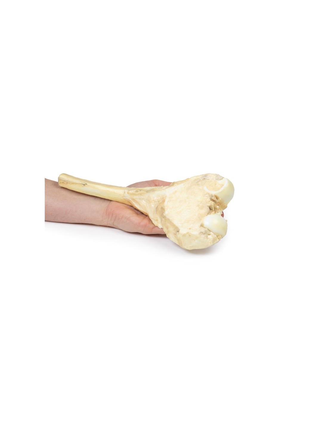 Osteosarcoma del fémur - Erler Zimmer... Osteosarcoma del fémur - Erler Zimmer...