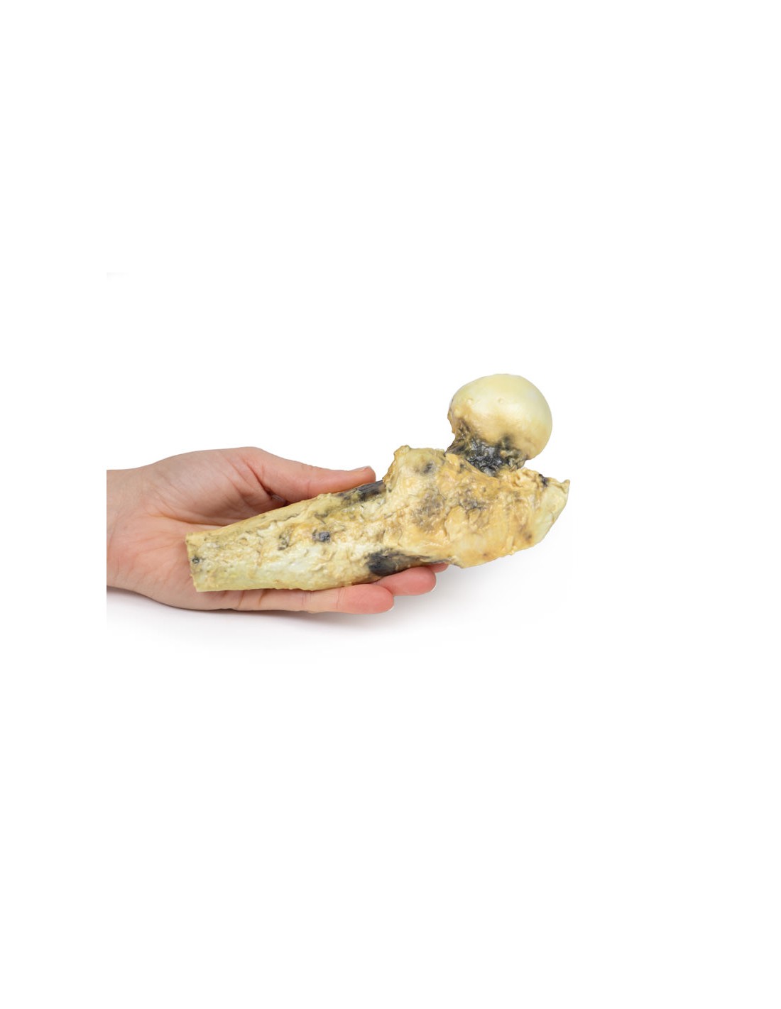 Osteosarcoma del fémur - Erler Zimmer... Osteosarcoma del fémur - Erler Zimmer...