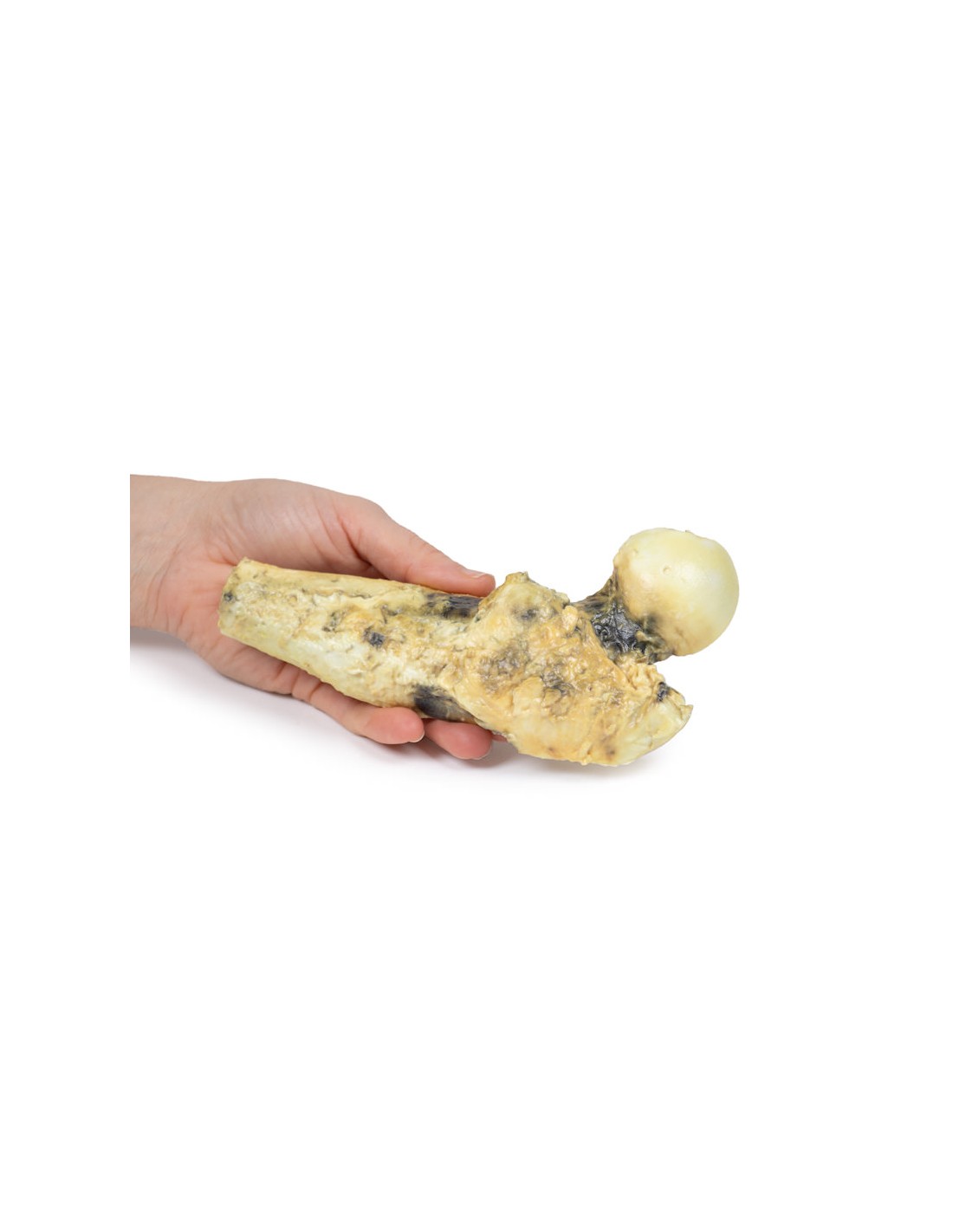 Osteosarcoma del fémur - Erler Zimmer... Osteosarcoma del fémur - Erler Zimmer...