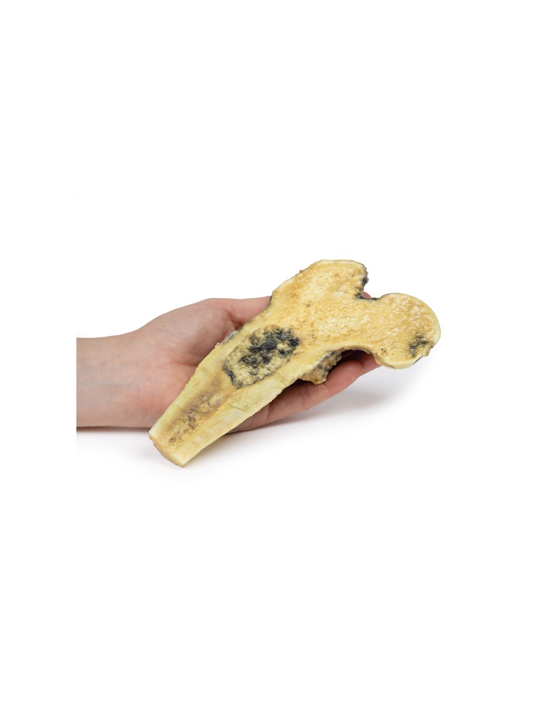 Osteosarcoma del fémur - Erler Zimmer... Osteosarcoma del fémur - Erler Zimmer...