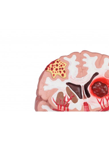 Patologías del cerebro humano Erler... Patologías del cerebro humano Erler...