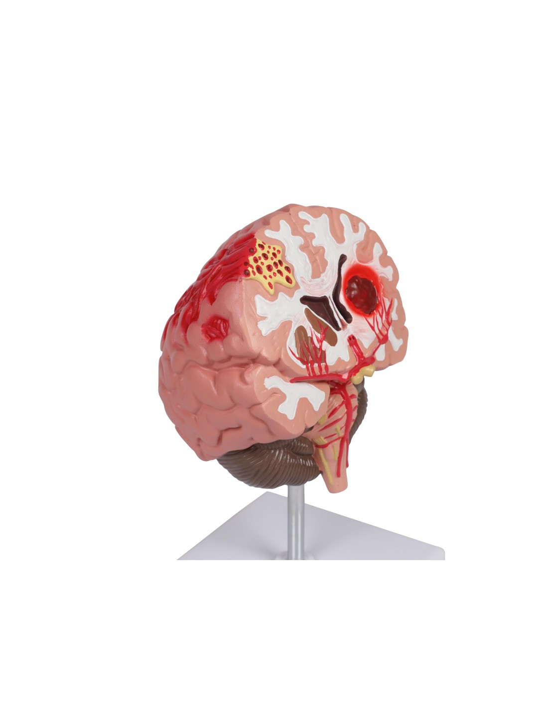Patologías del cerebro humano Erler... Patologías del cerebro humano Erler...