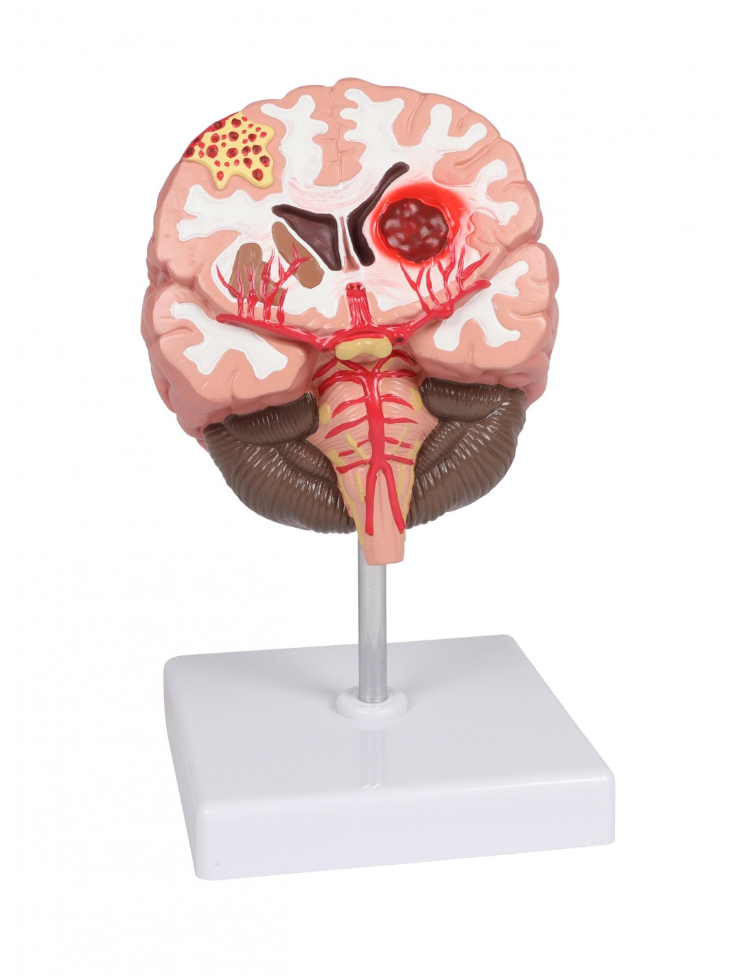 Patologías del cerebro humano Erler... Patologías del cerebro humano Erler...