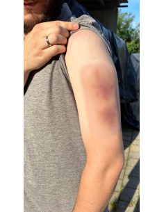 Moulage de hematoma de... 2